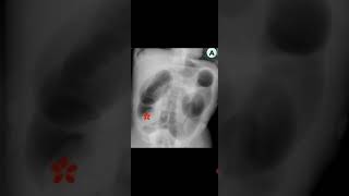 Pediatric Rectum and colon distended pneumatic enemaAwerenes of all [upl. by Rediah]