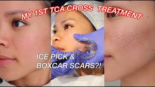 TCA CROSS FOR ACNE SCARS l Ice pick amp Boxcar scars on Asian Skin [upl. by Alrahc678]