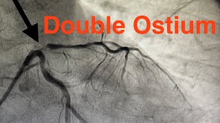 Double Ostium of Left Coronary Artery Proximal Lesion of LAD How To Position the Stent [upl. by Kcyred]