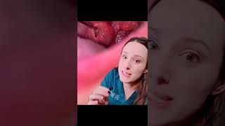 Tonsil stone removal dentist reacts 🤢 [upl. by Poul]