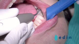 Ultrasoon reinigen bij parodontitis  Edin Dental Academy [upl. by Stortz]