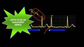 CURSO DE ELECTROCARDIOGRAFIA 47  EXTRASÍSTOLES SUPRAVENTRICULARES [upl. by Attah]