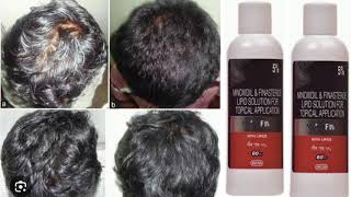 Morr F 5 Solution MINOXIDIL amp FINASTERIE LIPID SOLUTION FOR TOPICAL APPLICATION [upl. by Audrit]