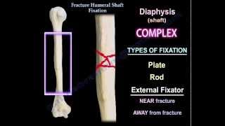 Humeral Shaft fracture Fixation  Everything You Need To Know  Dr Nabil Ebraheim [upl. by Lapides277]