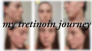 8 MONTH TRETINOIN JOURNEY UNSPONSORED APOSTROPHE REVIEW [upl. by Guthry]