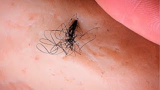 Removal of ingrown hair [upl. by Marlo]