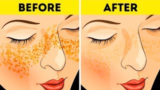 How to Get Rid of Acne Scars In Just 3 Days [upl. by Itsrejk]