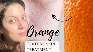 Treatment for textured skin I Oily Skincare I Treatment for large open pores and textured skin [upl. by Yniar]