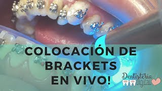 Colocación de Brackets en VIVO  Putting on Braces  LIVE [upl. by Kannry]