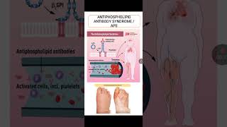 Antiphospholipid Antibody Syndrome [upl. by Renaxela]