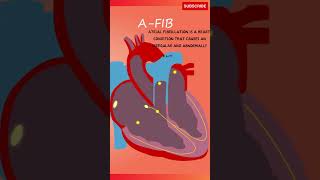 Atrial Fibrillation Sound  Heartbeat Sound and Explanation heartbeat atrialfibrillation [upl. by Leahcimal]