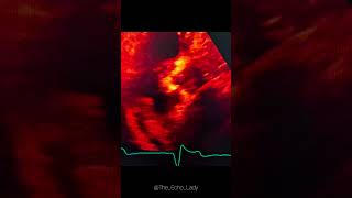 Endocarditis vs Thrombus🩸🦠 endocarditis echocardiography cardiologie cardiology [upl. by Ahterod]