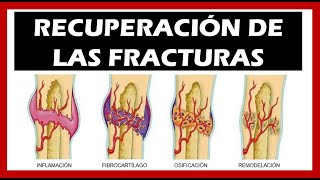 Consolidación de las Fracturas 🦴 Tiempo Fases [upl. by Ayama]