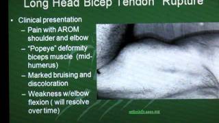 Long Head Biceps Tendon Rupture [upl. by Dempstor]