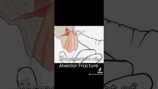 Management of Alveolar Fracture [upl. by Flanders]