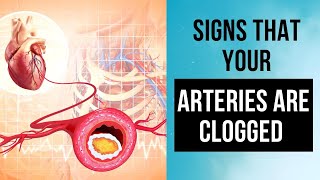 Are Your Arteries Clogged Watch for These Warning Signs [upl. by Teria]