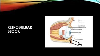 RETROBULBAR ANESTHESIA [upl. by Kutzer]