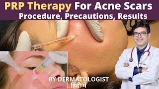 PRP Treatment For Face Acne Scars  PRP Therapy  Platelet Rich Plasma Treatment In Jaipur [upl. by Adela]