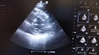 Global hypokinesia of left ventricle improved after Rx in PSAX echo view at mid ventricular level [upl. by Yong188]