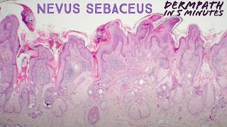 Nevus sebaceus Dermpath in 5 Minutes pathology dermatology dermatopathology [upl. by Aneehsar]