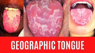 GEOGRAPHIC TONGUE  Benign Migratory Glossitis  Erythema Areata Migrans What is Geographic Tongue [upl. by Eiram]