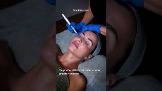 Tratamiento facial regenerador de colágeno con Microneedling [upl. by Boylston758]