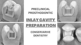 Dental Inlay Cavity Preparation  Taper  Bevel [upl. by Cacia]