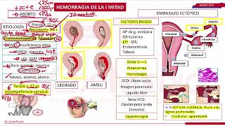 El ABORTO TIPOS Y CAUSAS MAS FRECUENTES [upl. by Eihtak]