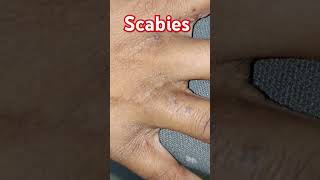 scabies skincare fungaldisease skin diseases [upl. by Kirstyn]