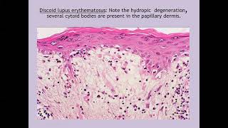 Lecture59 Discoid and Subacute Cutaneous Lupus Erythematosus Rooks chapter 51 [upl. by Candless655]