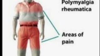 Polymyalgia rheumatica lecture [upl. by Nortal546]