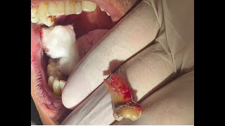 Extraction of mandibular right wisdom using straight elevator [upl. by Adnilemreh247]