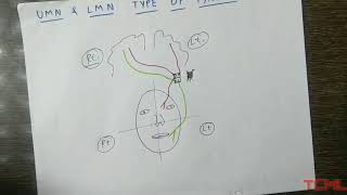 Upper and lower motor neuron type of facial palsy [upl. by Okomom277]