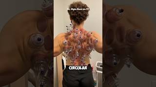 Cupping Therapy 😨 EXPLAINED [upl. by Ennahoj]