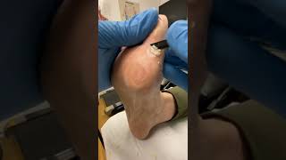 Watch Podiatrist Debride Wart After Salicylic Acid Treatment  Hard Skin Removal with Docpods [upl. by Akenahc]