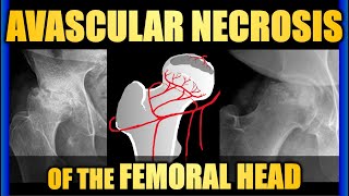 Avascular Necrosis of the Femoral Head hippain trauma radiology [upl. by Bellis887]