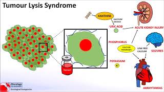 Tumour Lysis Syndrome [upl. by Salohcin571]