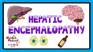 Hepatic Encephalopathy  Pathophysiology Stages and West Haven Criteria [upl. by Suneya]