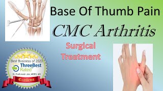 Surgical management of First CMC Arthritis [upl. by Odlanir]