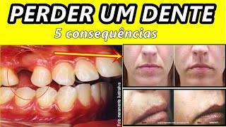 5 consequências TERRÍVEIS de perder um dente [upl. by Udelle]