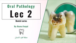 Oral Pathology Dental caries  اورل باثو المحاضرة الثانية [upl. by Akenahc]