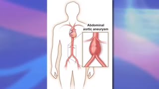 Risks and Benefits of Endovascular Abdominal Aortic Aneurysm Repair EVAR [upl. by Silenay]