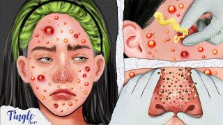 ASMR Satisfying Acne Removal Animation  Whitehead amp Blackhead Removal  Stop Motion [upl. by Nnad]