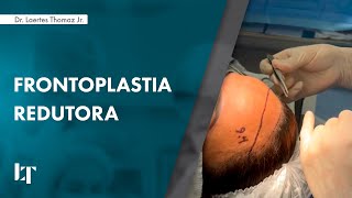 FRONTOPLASTIA REDUTORA  DR LAERTES THOMAZ JR [upl. by Baoj]