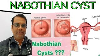 NABOTHIAN CYSTCAUSE  SYMPTOMS  HOMEOPATHIC MEDICINE [upl. by Annaitsirk]