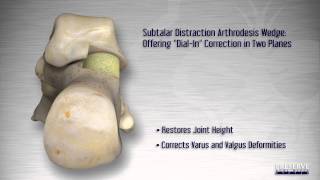 Subtalar Joint Distraction [upl. by Dickinson]