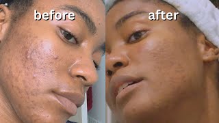 Hormonal Acne Journey Tretinoin Progress After Years [upl. by Adar]