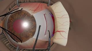 Strabismus surgery Recession [upl. by Kirby882]