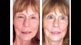 Microcurrent Facelift and the eyes what you can expect after a series of treatments [upl. by Dita38]