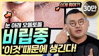 눈밑에 비립종 왜 생길까 피부과의사가 알려주는 비립종 똑 없애는 예방법 4가지 깨끗한 눈가만들기 [upl. by Ecirahs908]